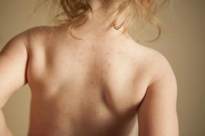 Eczema – All your questions answered